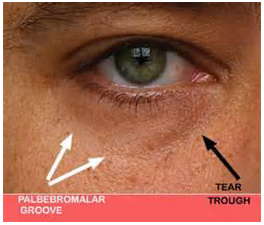 Tear trough and infraorbital are